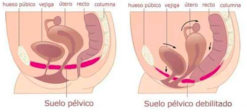Porqué son necesarios los ejercicios Kegel. Prolapsos e incontinencia urinaria y rectal